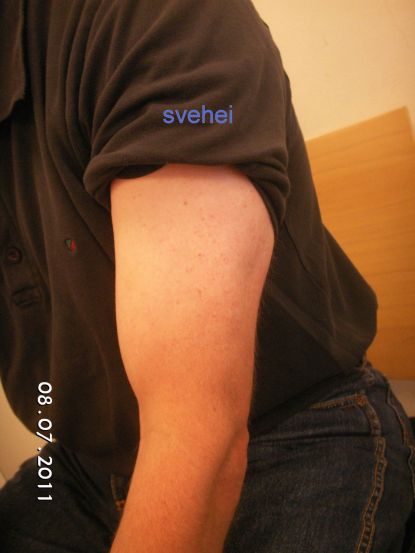 Raske overarm (Distal bicepsseneruptur med raske overarm til sammenligning)