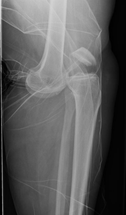 Rtg., side-optagelse, viser knæluksation