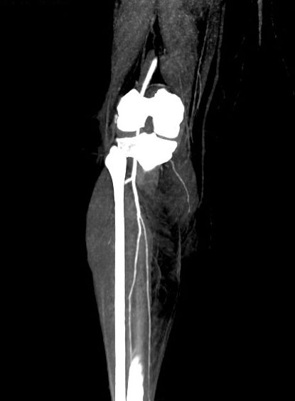 CT-angiografi, uden tegn på A. poplitea læsion